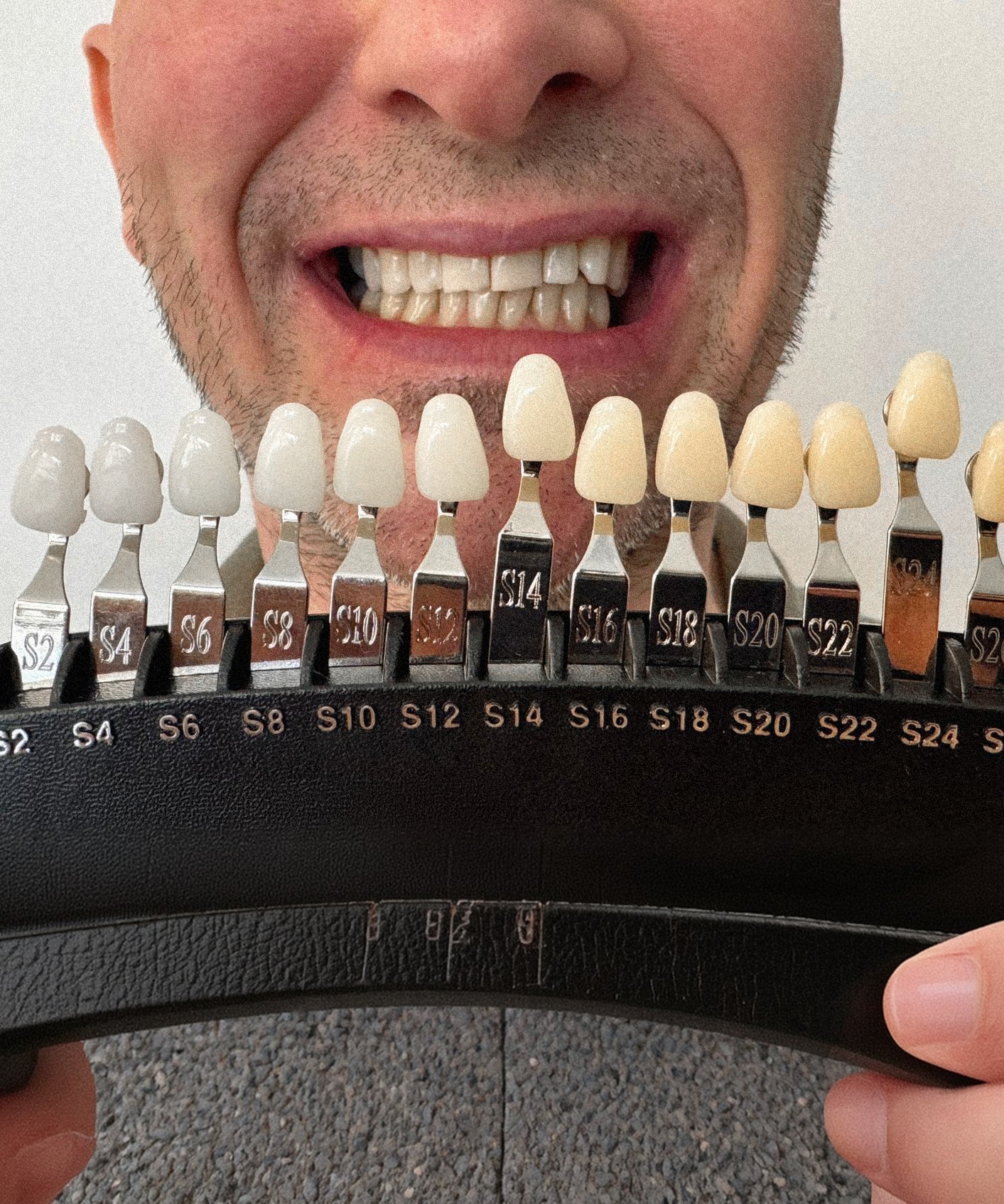 Teeth after bleachingtreatment with before/after comparison of shades